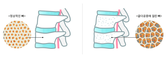 정상뼈-골밀도와-골다공증환자의-골밀도