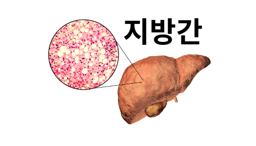 지방간-원인과 증상