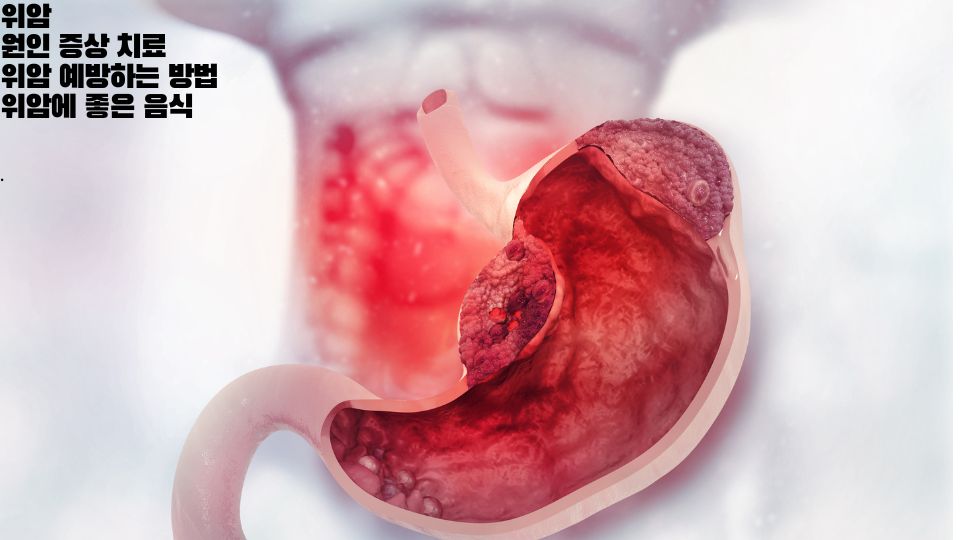 위암 원인 증상 치료, 위암 예방 위암 생존율 위암 초기증상 자가진단