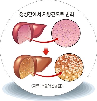 지방간 증상