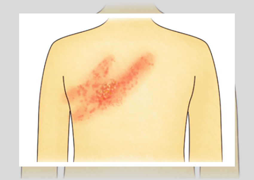 대상포진 4가지 증상들로 발열, 붉은 발진, 가려움, 수포의 이미지