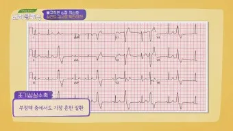 심전도 검사 심장 부정맥 원인 치료법_3