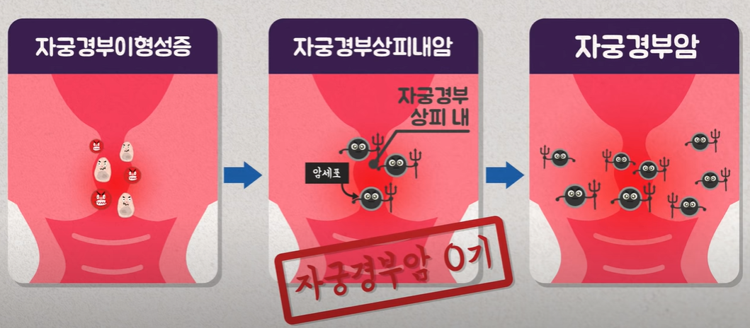  자궁경부암의 원인과 초기증상, 정기 검진과 예방접종으로 막자