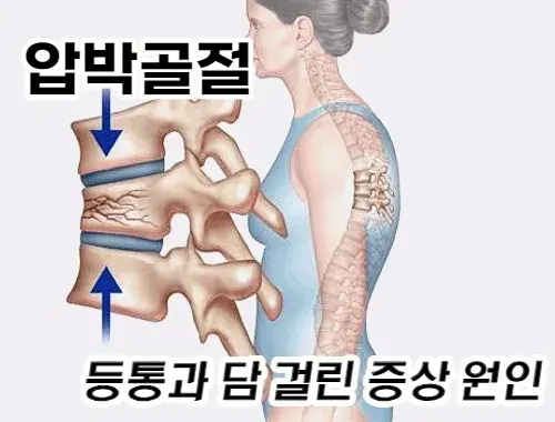 척추에-압박골절이-발생하면-등통이-생기게-됩니다.