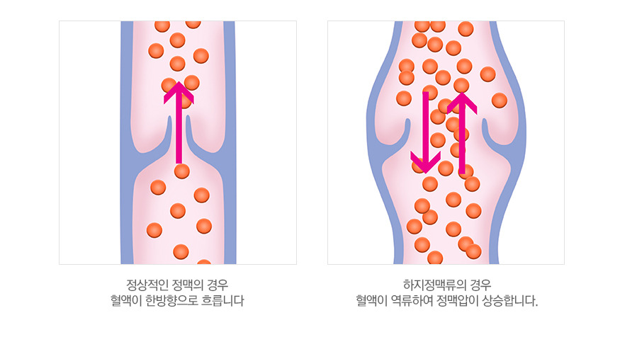 하지정맥류가 방치될 경우 발생하는 가장 큰 문제는 허혈성 손상이다.