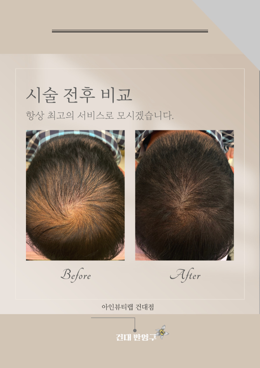  건대두피문신 SMP두피문신 부분두피문신으로 인하여 자신감UP! 과연?