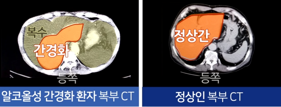  간경화 초기증상 간암과의 차이는?