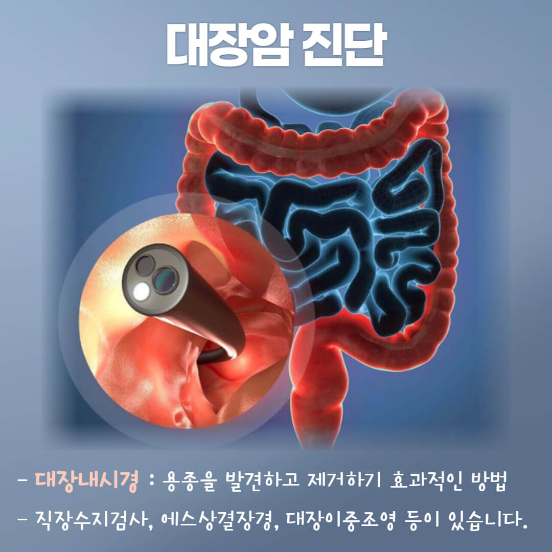 대장암 진단