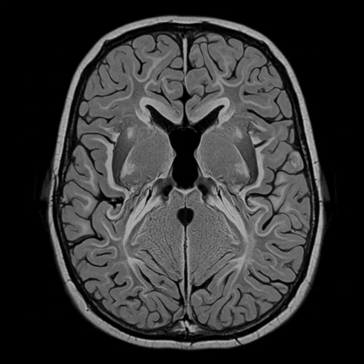 뇌 MRI