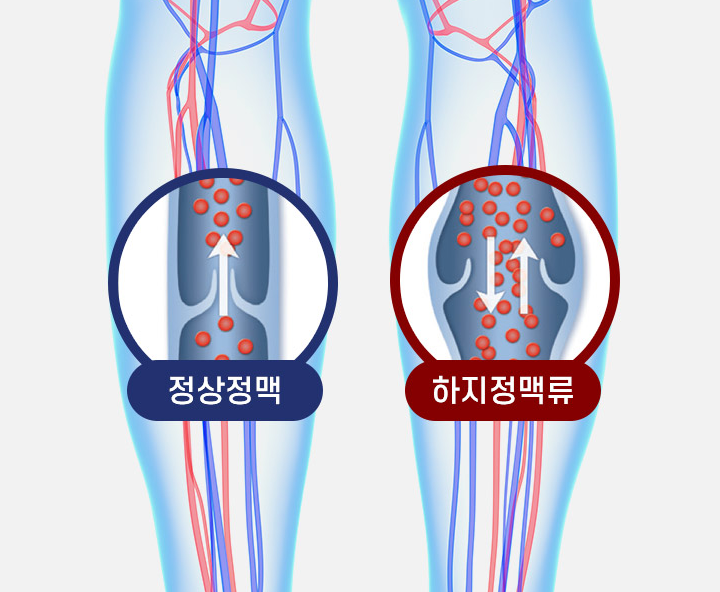 하지정맥류 증상