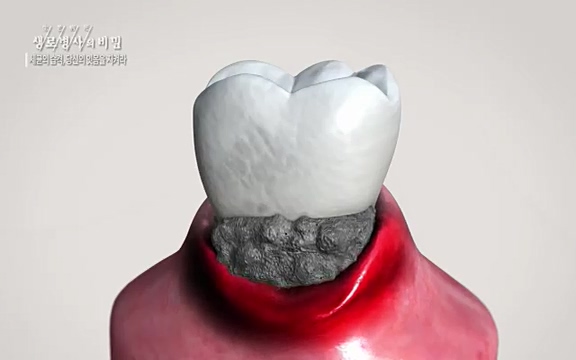 [792회] 생로병사의 비밀 - KBS[세균의 습격, 당신의 잇몸을 지켜라!] 감기보다 병원을 더 자주 찾게 만드는 질병이 있다. 바로 치주질환이다. 2020년 외래 다빈도 질병 1위를 차지한 치은염 및 치주질환 환자는 1,637_20220505_140305.916.jpg