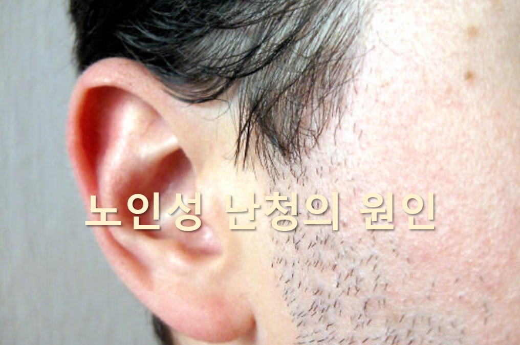  노인성 난청을 방치하게 되면 치매와 우울증 발병률 높아져