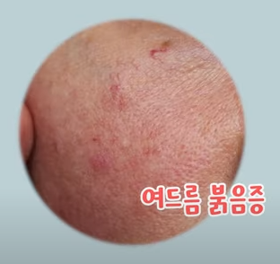  피부과에서 알려주는 여드름 흉터 자국 예방법
