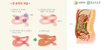 배가 부글부글 설사 원인파악 대처법_12