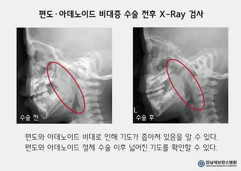 아데노이드 비대