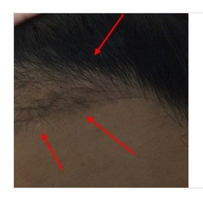  모발이식수술 실패 경험과 대비방법 안내