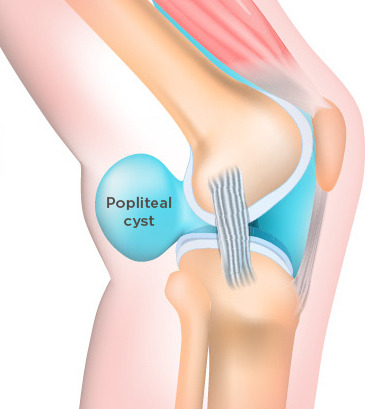 Baker's cyst (popliteal cyst)