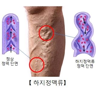 하지 정맥류 증상&amp;#44; 원인