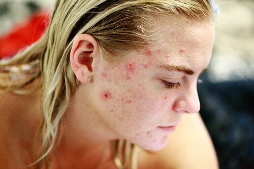 acne_women