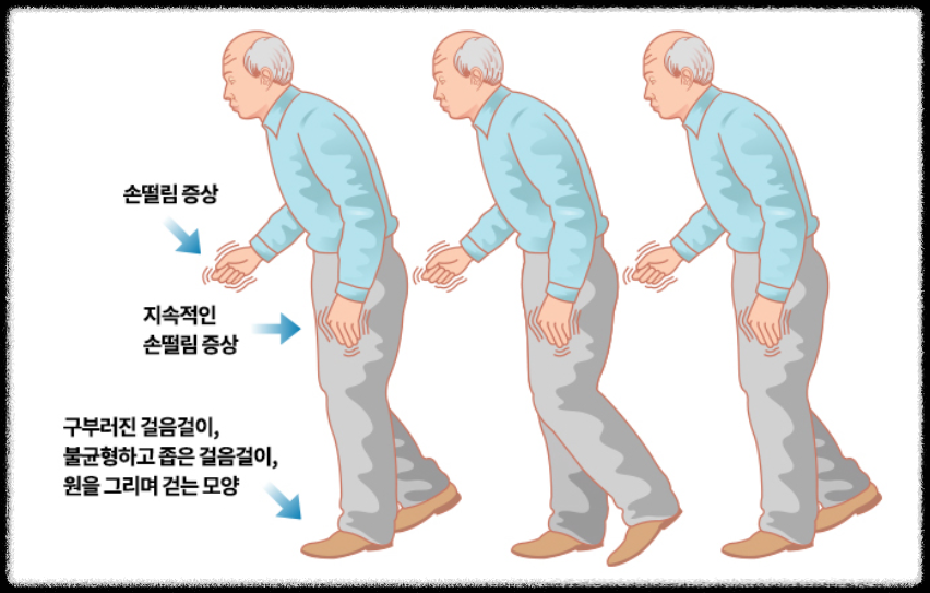 파킨슨병, 파킨슨증후군의 증상