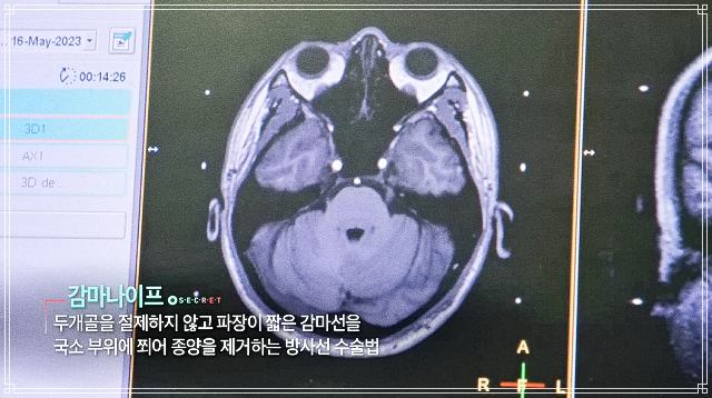생로병사의 비밀 874회 벼랑 끝 폐암 4기, 싸워볼 만하다, 감마 나이프, 뇌 전이, 표적 항암제, 치료, 면역항암제 정보