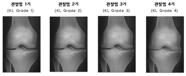 무릎 안쪽 통증 증상 조기검사 후 본인의 맞는 치료선택