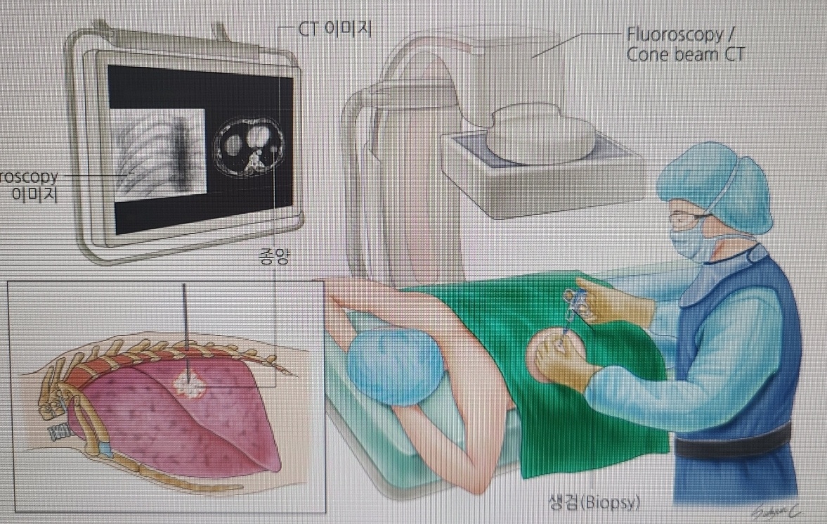 폐암진단