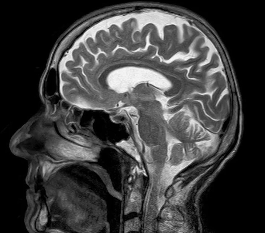 MRI비용 -뇌 구조