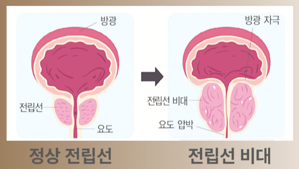 노년 남성 전립선 비대