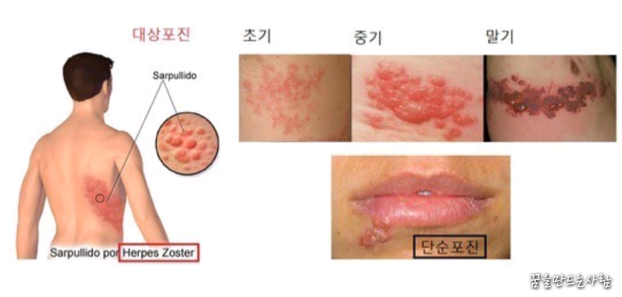  대상포진 초기증상 및 치료방법
