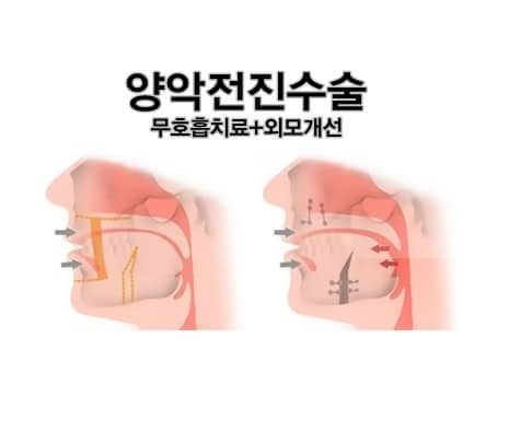 양악 전진술