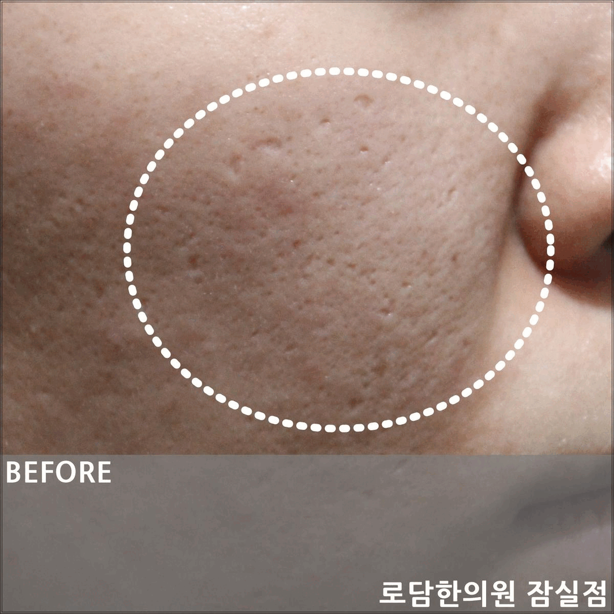  강동구 여드름 흉터 패인 자국 로담한의원 새살침 치료 과정