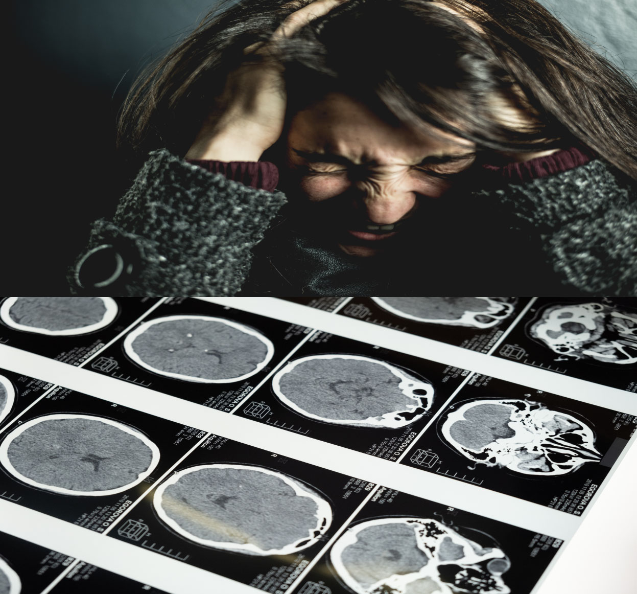 알츠하이머로 인해 스트레스를 받고 있는 중년 여성의 사진과 뇌 엑스레이 사진이 보이는 이미지