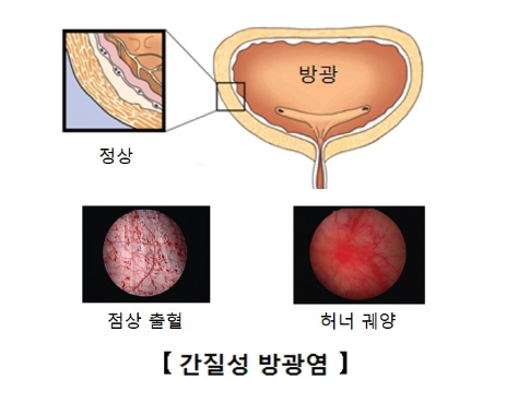 간질성 방광염 - 출처 -서울 아산병원