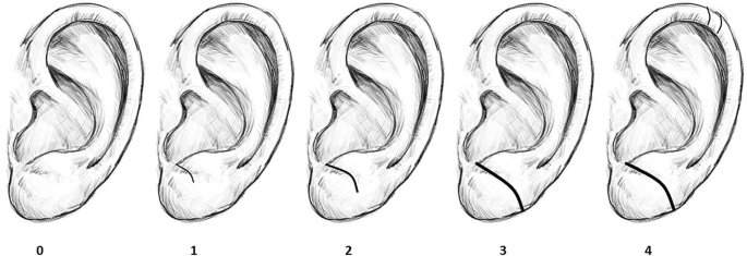 치매 뇌졸중 귀주름 연관 관계