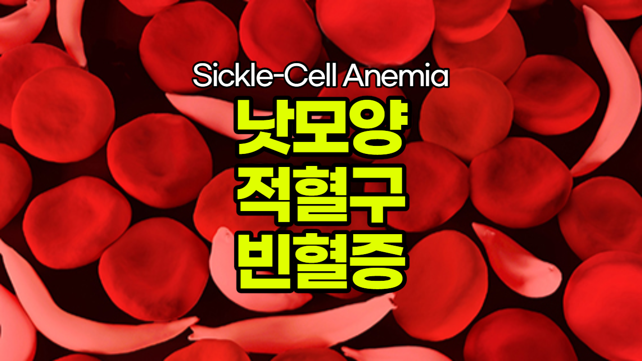  낫모양 적혈구 빈혈증 특징 증상 치료법