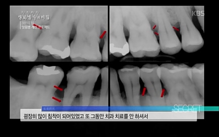 [670회] 생로병사의 비밀 - KBS670회] 생로병사의 비밀.ts_20220505_143150.903.jpg