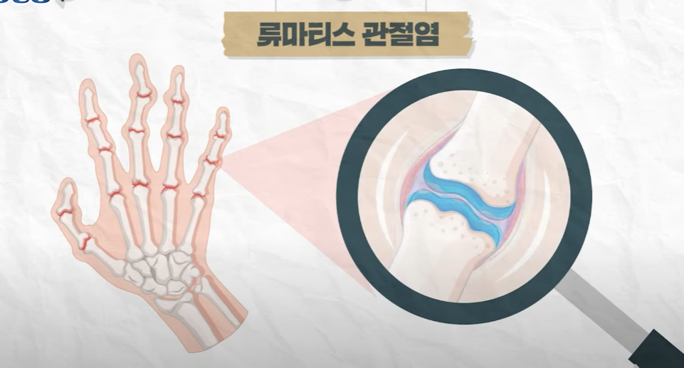  류마티스 관절염 전조증상 초기에 치료를 놓치면 큰일납니다