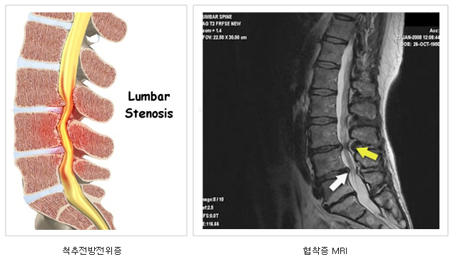  추간판 팽창, 척추관 협착, 양측신경공 협착 증상과 대처법