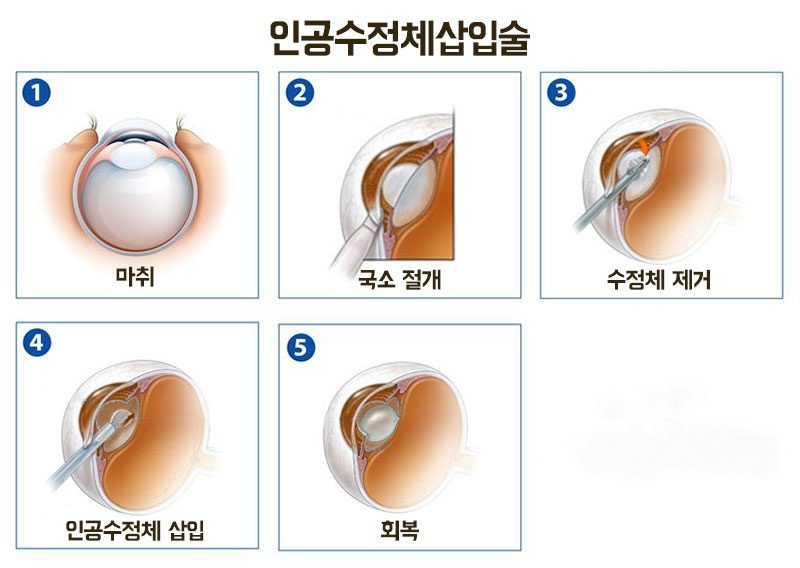 노안수술