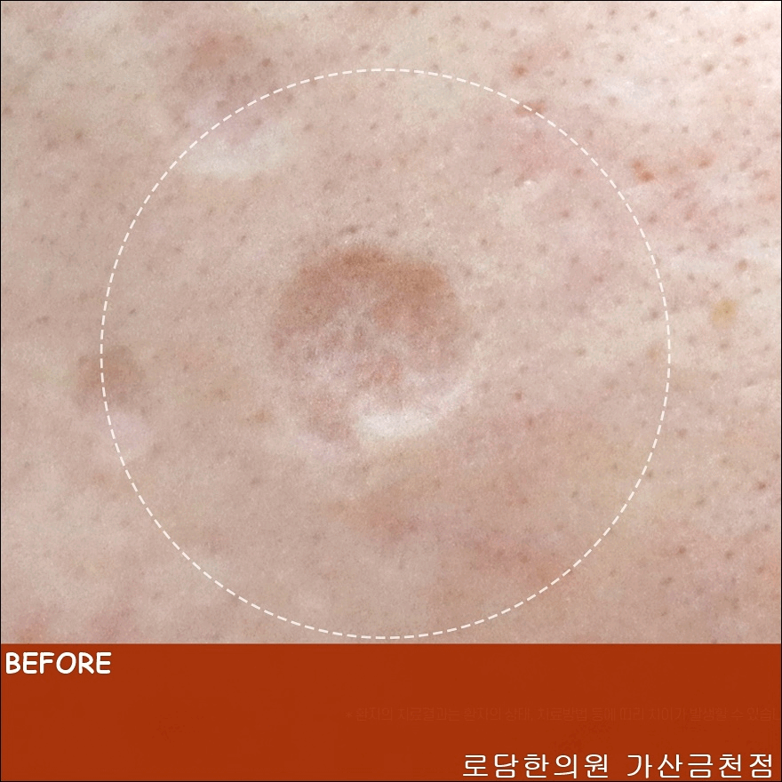  부천수두흉터 제거 곰보자국 치료 과정 새살침