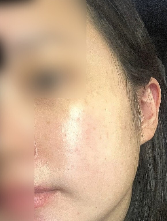  IPL레이저 후기, 가격/통증 솔직한 후기(사진 있음)