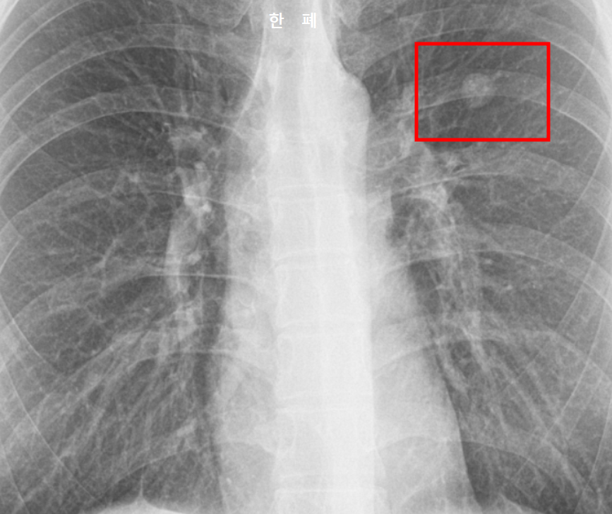 폐결절 커짐&#44; 자라는 속도 X-ray 사진