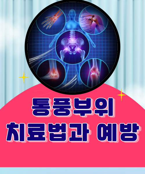  치맥을 자주드시나요? 많이 먹으면 통풍처럼 무서운 질병에 걸릴수있어요