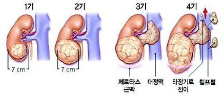 신장암 초기증상 및 3기·4기 생존율, 꼭 알아야 할 신장암 검사 치료 방법