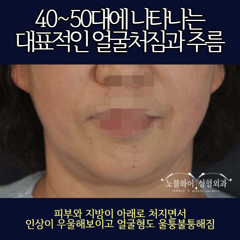  안면거상술 추천 병원 실사례 많네요