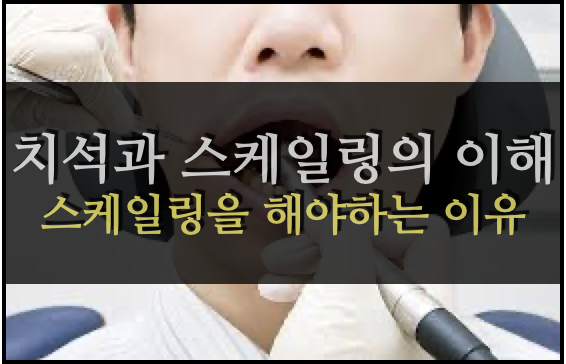  치석과 스케일링의 이해: 무조건 스케일링을 해야하는 이유