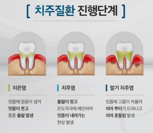 치주질환 진행단계