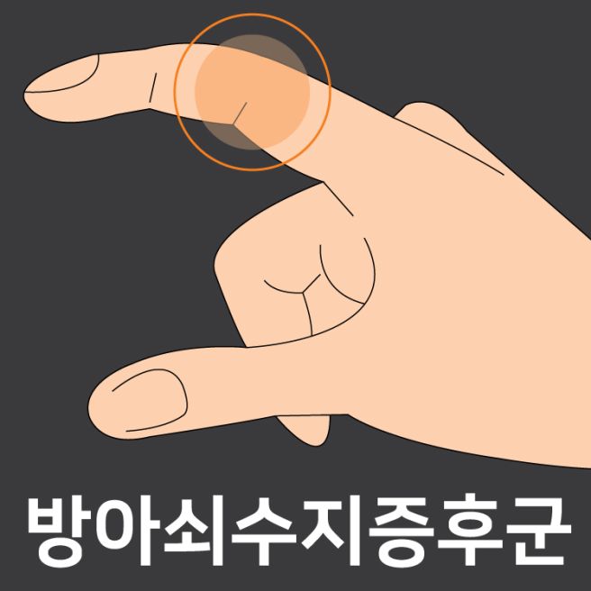 방아쇠 수지 증후군