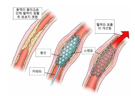 관상동맥-풍선-확장-성형술-및-스텐트-삽입술